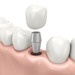 Advantages Of Excellent Dental Bridge Work