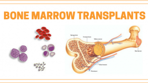 Bone Marrow Transplantation and Treatment