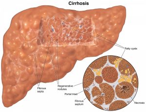 How to Detect Liver Cirrhosis?