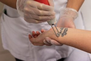 Different Methods Used By Tattoo Removal In Ludhiana